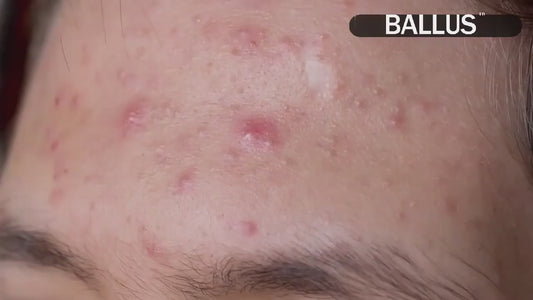 Pore Cleaning Device | جهاز تنظيف المسام – 5 Suction Levels & USB Rechargeable